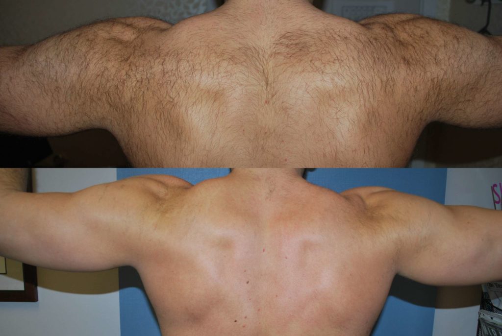 before & after hair removed man's back - laser hair removal bellevue wa