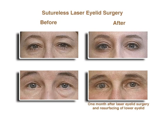 eyelid surgery21