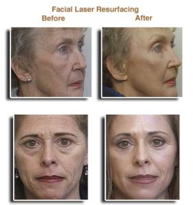 facial laser resurfacing wo