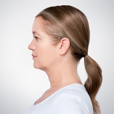 kybella before Stern Center for Aesthetic Surgery