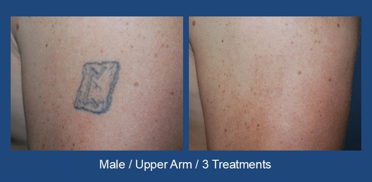 Laser Tattoo Removal Seattle Stern Center for Aesthetic Surgery 1