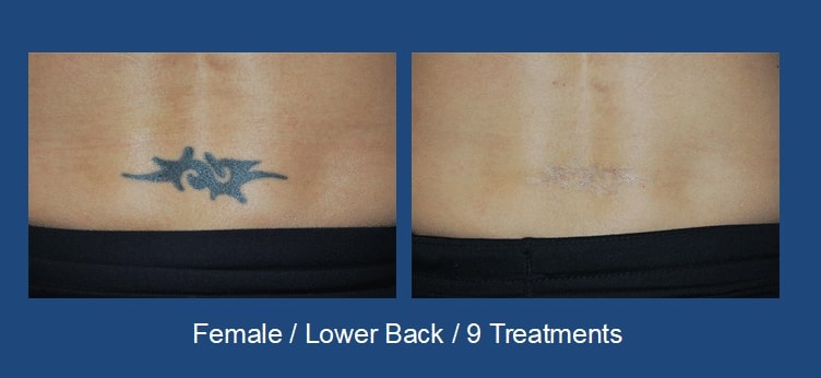 Laser Tattoo Removal Seattle Stern Center for Aesthetic Surgery 1