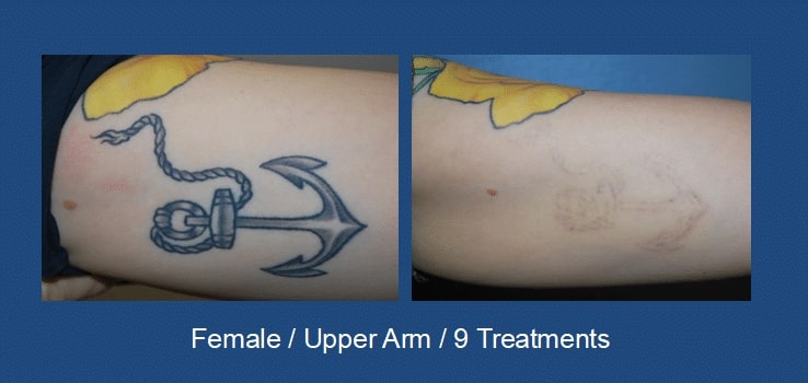 Laser Tattoo Removal Seattle Stern Center for Aesthetic Surgery 3