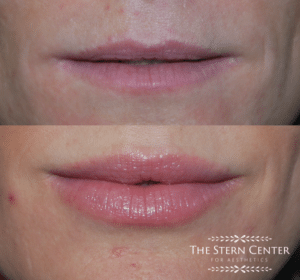 Before After Lips injected with Juvederm at The Stern Center | Lip Filler in Bellevue WA