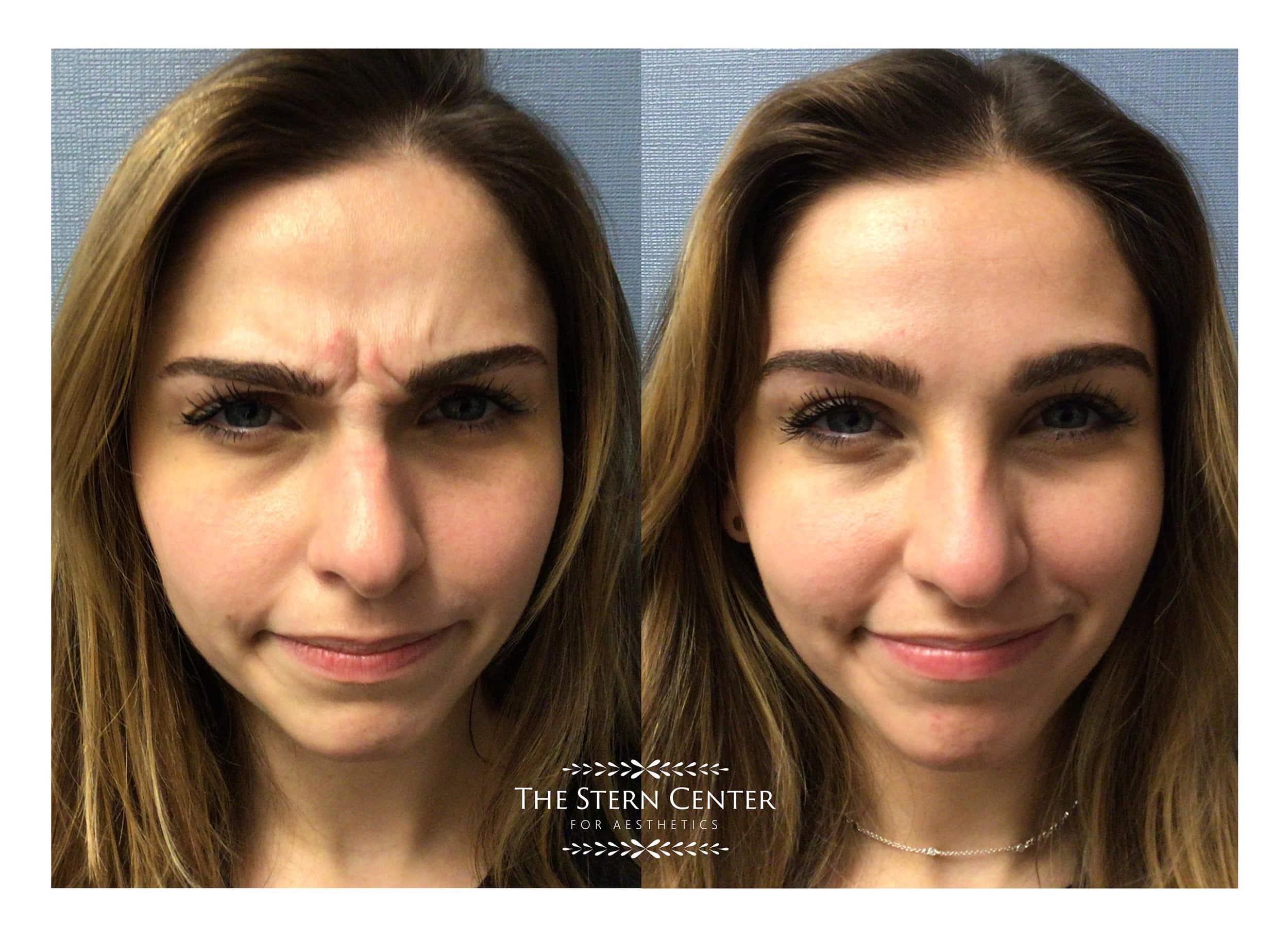 Botox Before & After Bellevue WA