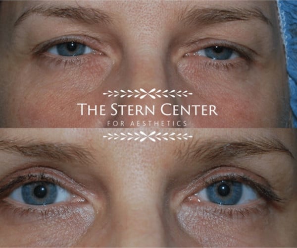 before and after laser eyelid surgery near Bellevue, WA