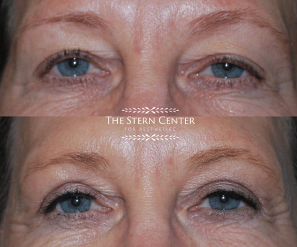 before and after laser eyelid surgery in Bellevue, WA
