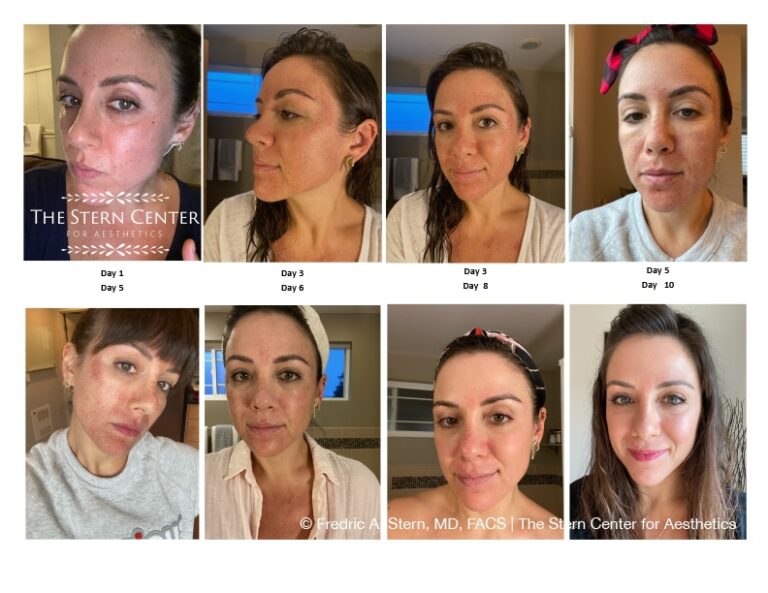 Sciton HALO Laser Treatment Seattle & Bellevue WA