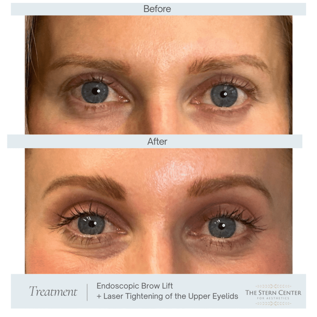 Before and After Image: Endoscopic Brow Lift & Laser Tightening of the Upper Eyelids - front