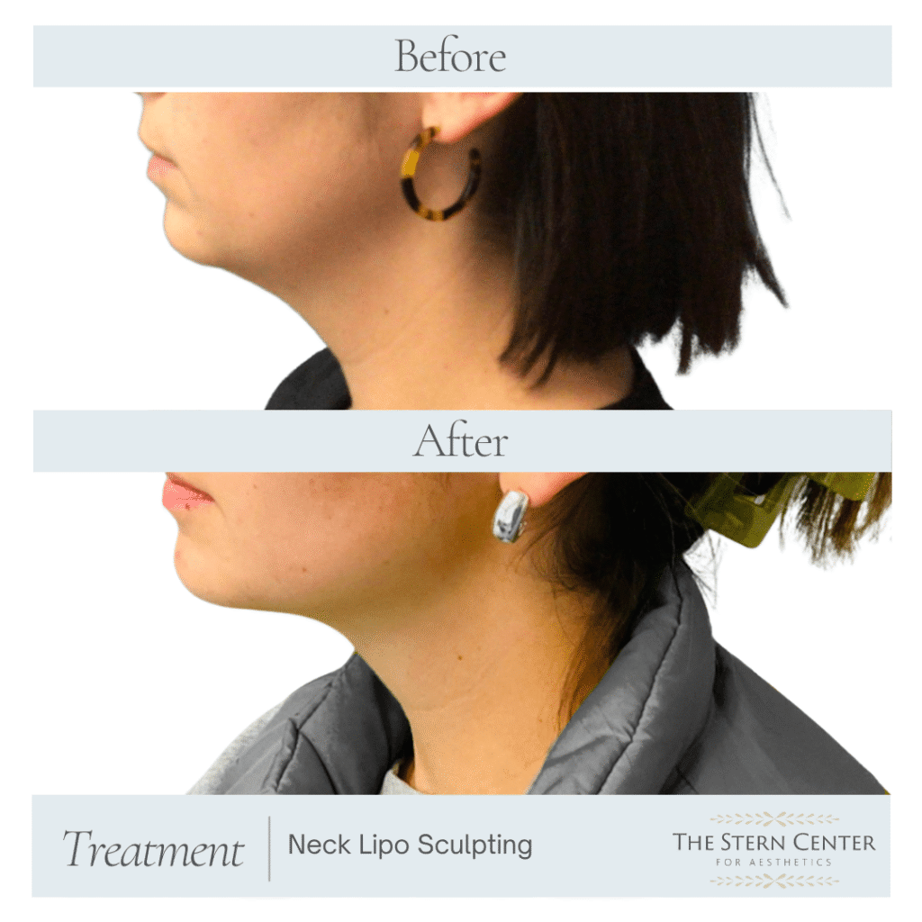 Before and After Image: Neck Liposuction - front