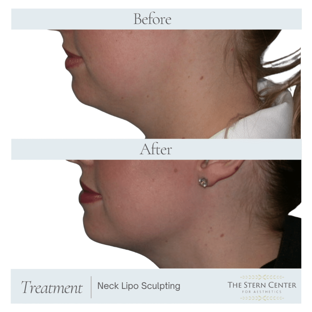 Before and After Image: Chin / Neck Liposuction - front