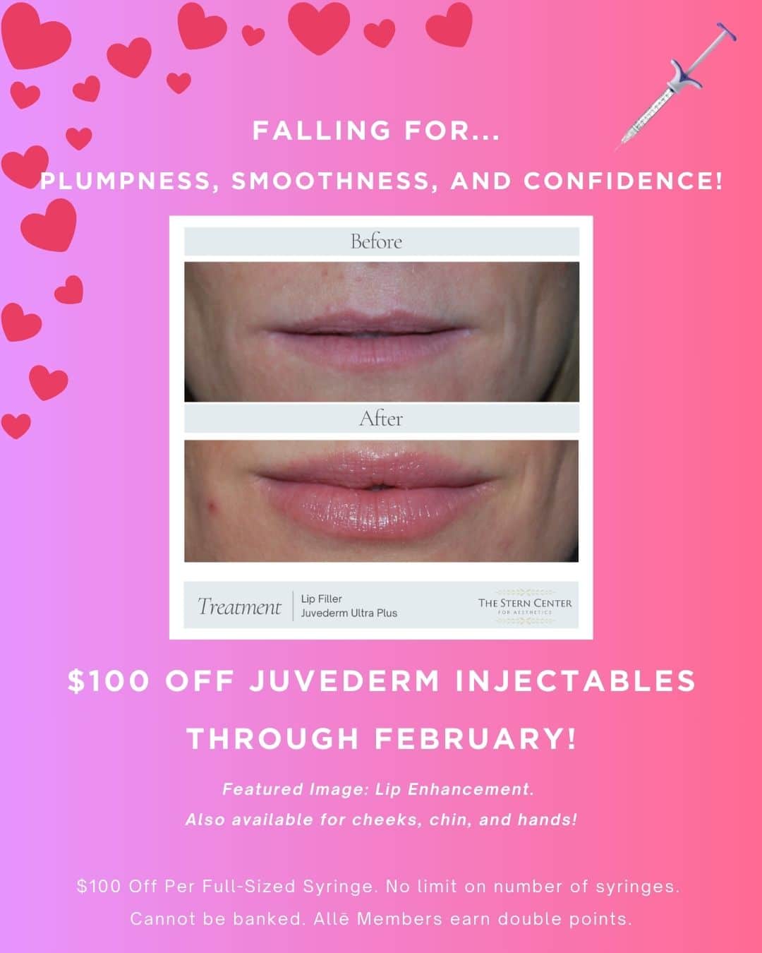Feb 2026 Juvederm