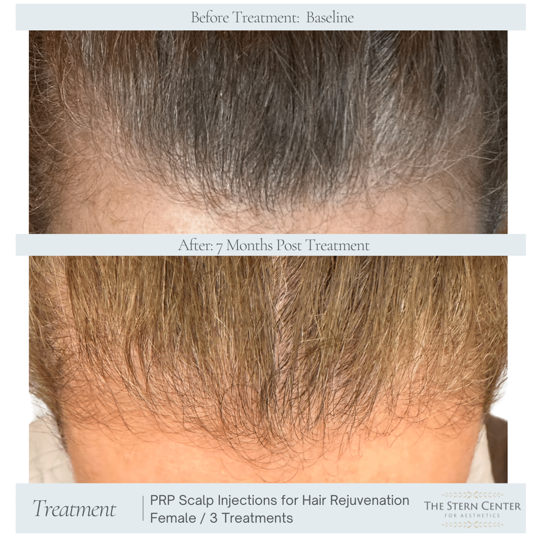 Before and After Image: PRP Treatments - 