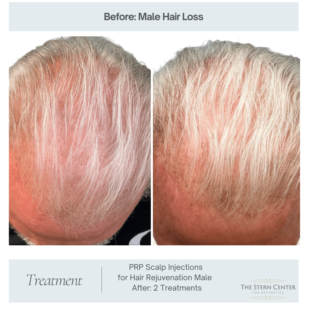Before and After Image: PRP Treatments - front
