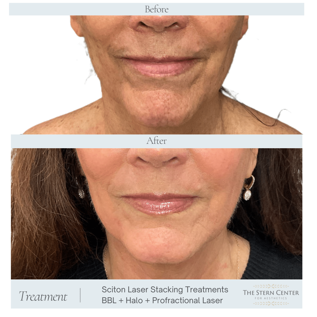 Before and After Image: Sciton Laser Stacking Treatments BBL + Halo + Profractional Laser