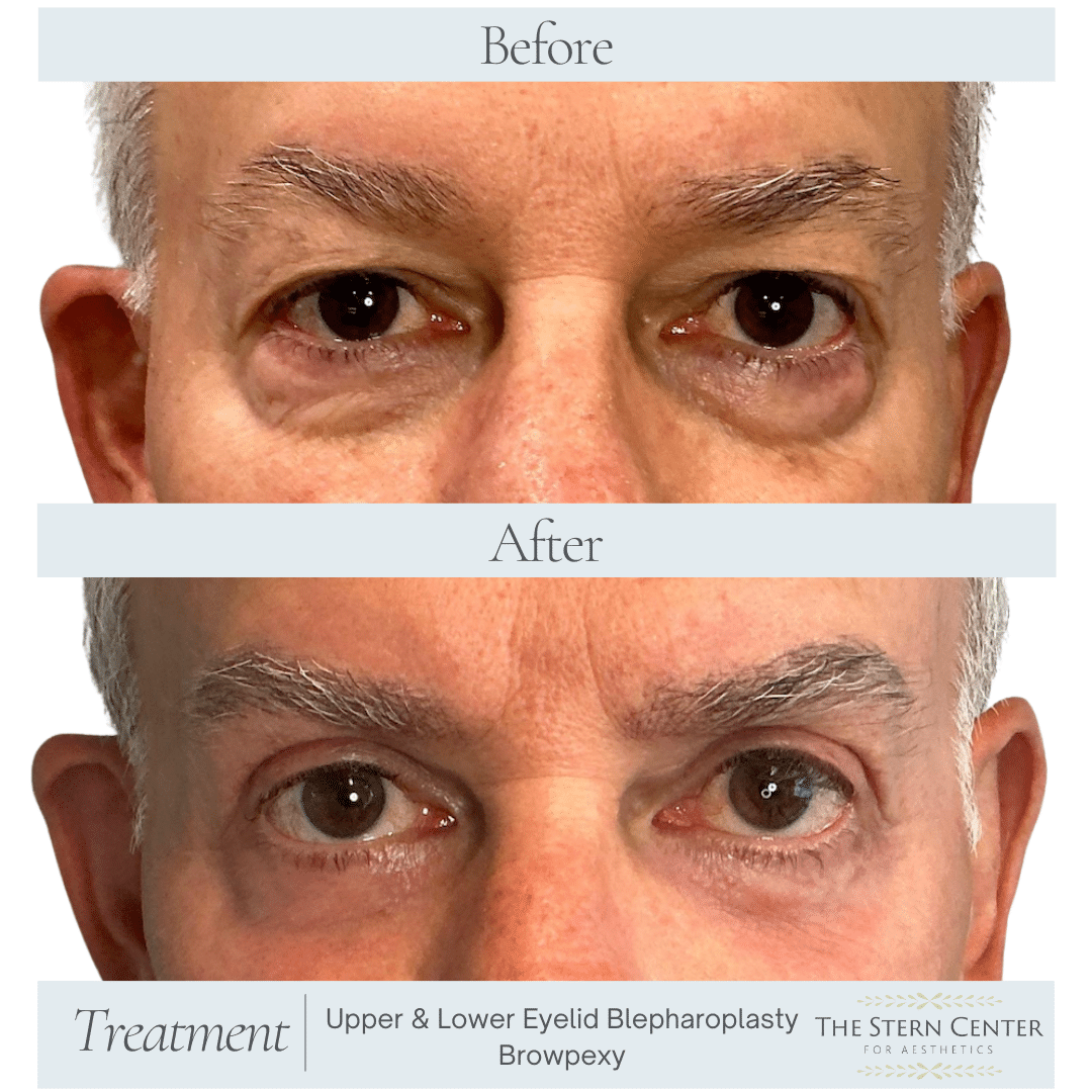 Before and After Image: Eyelid Surgery - front