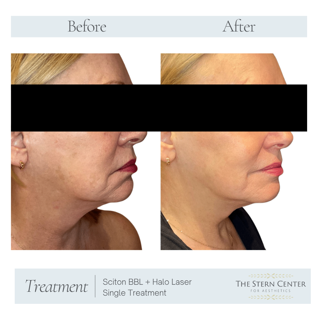 Before and After Image: Sciton BBL + Halo Laser Single Treatment