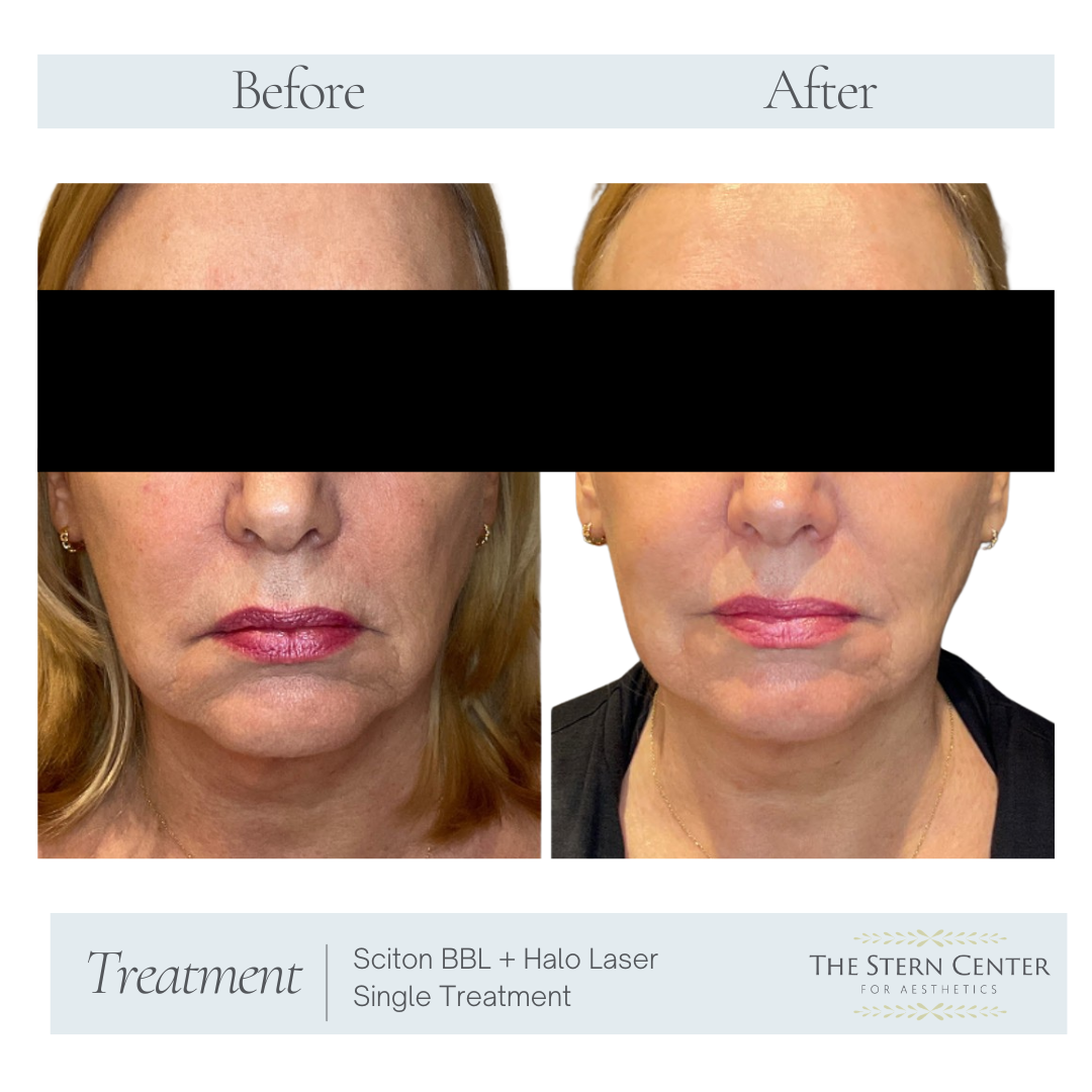 Before and After Image: Sciton BBL + Halo Laser Single Treatment - front