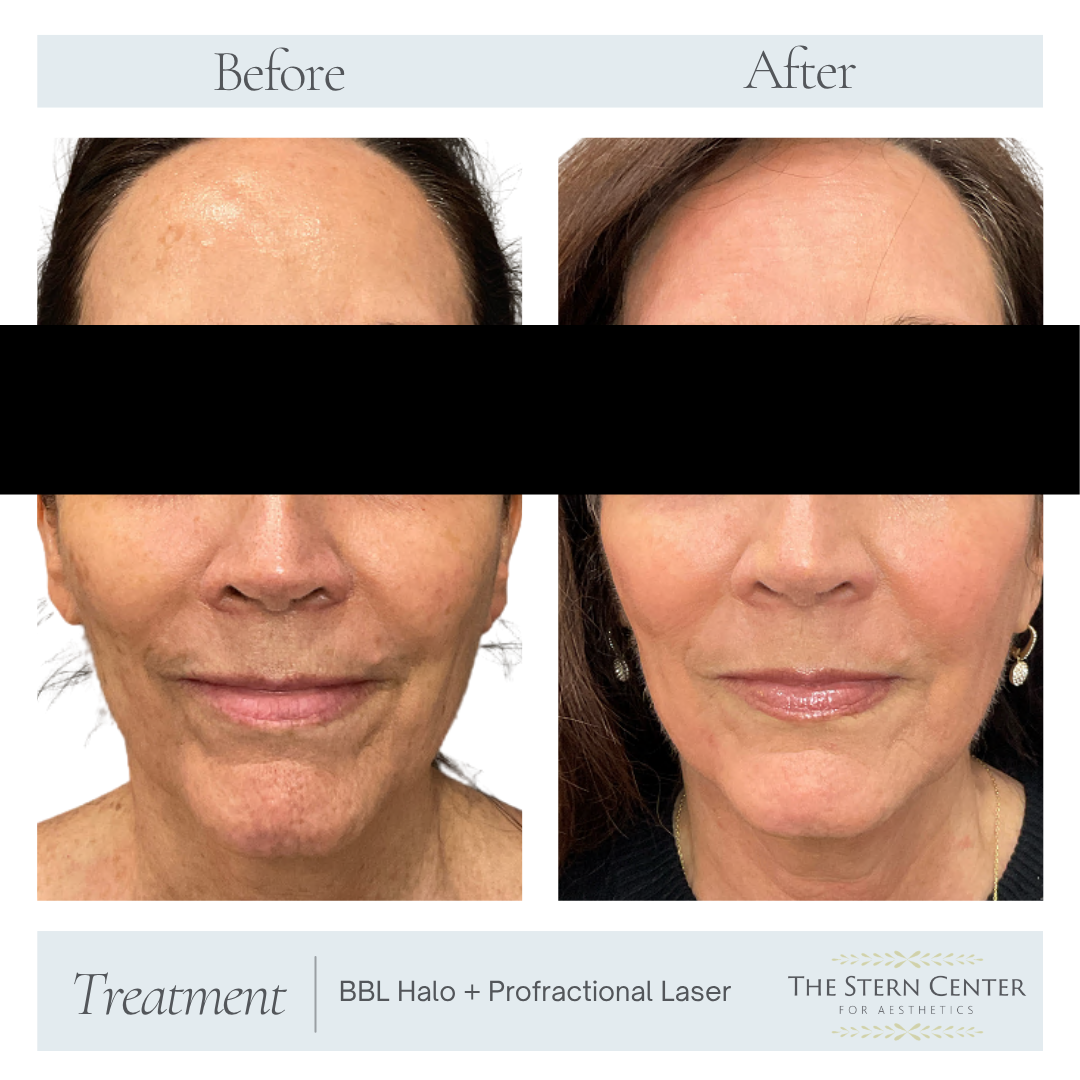 Before and After Image: BBL Halo + Profractional Laser