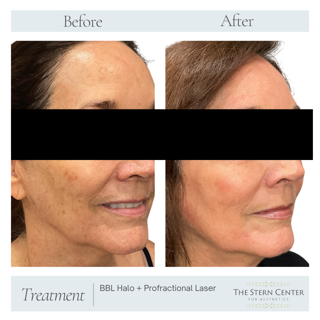Before and After Image: BBL Halo + Profractional Laser