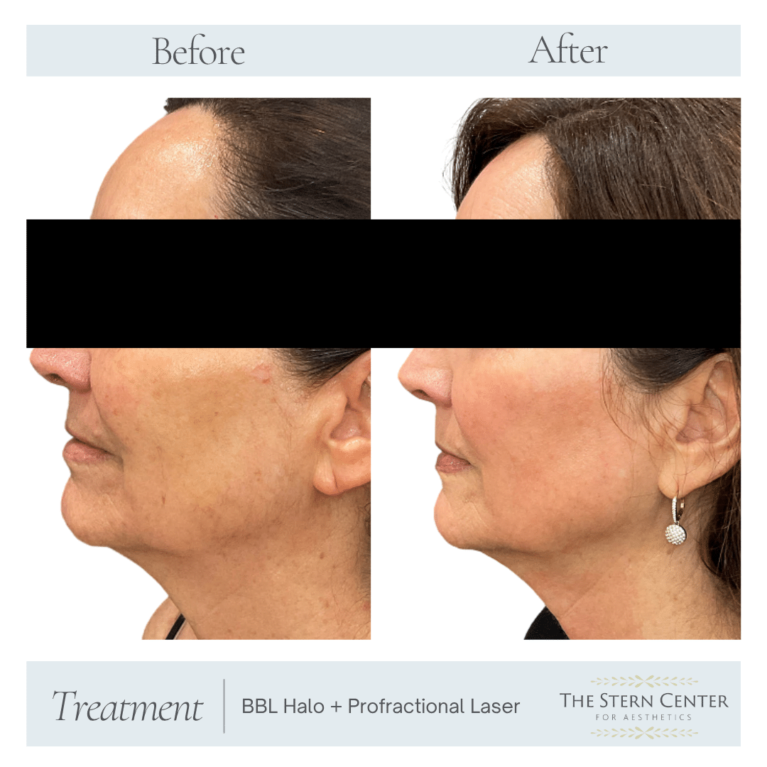 Before and After Image: BBL Halo + Profractional Laser
