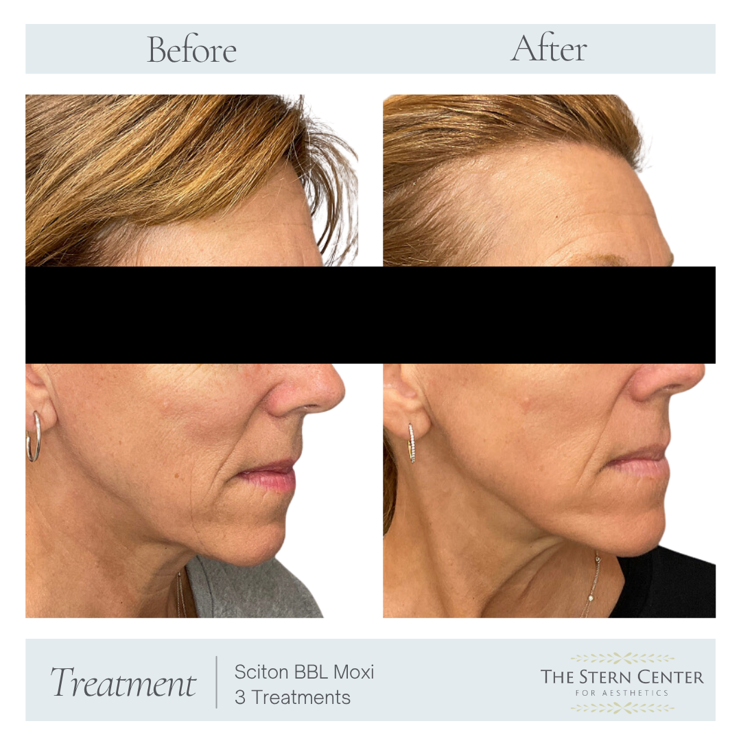 Before and After Image: Sciton BBL Moxi 3 Treatments - front