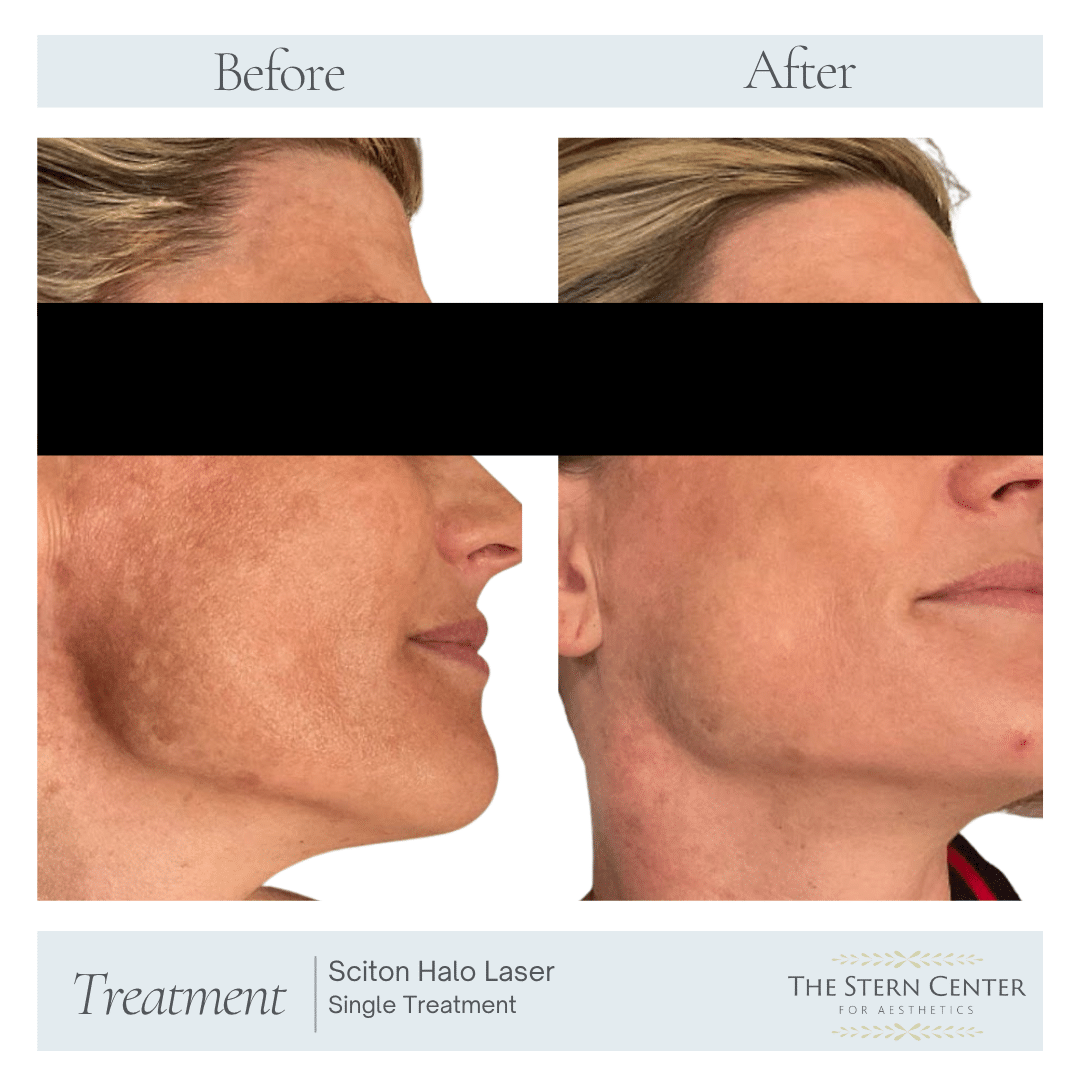 Before and After Image: Sciton Halo Laser Single Treatment - right-side