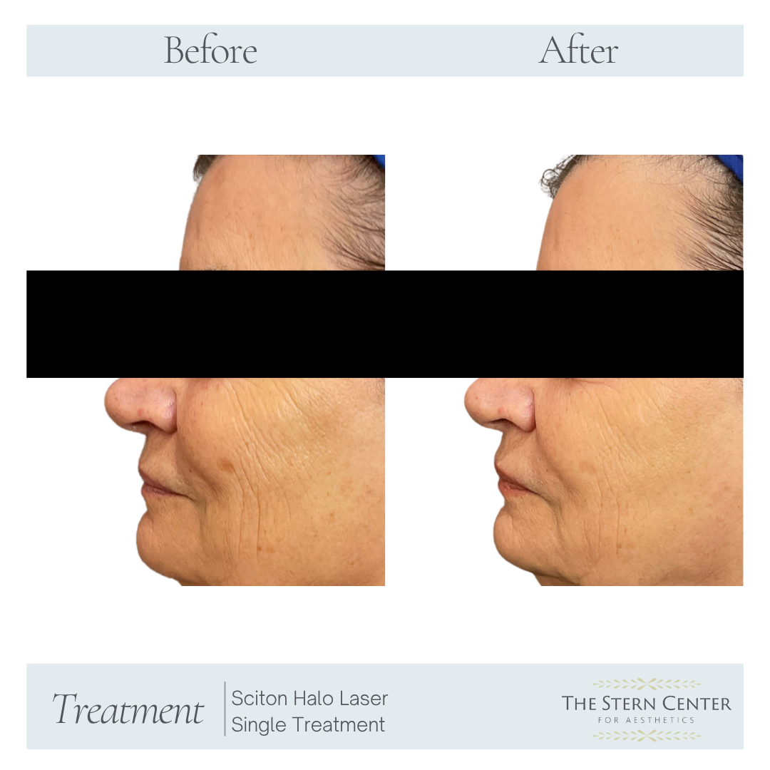 Before and After Image: Sciton Halo Laser Single Treatment - left-side
