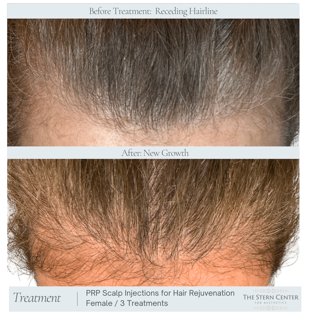 Before and After Image: PRP Treatments - front