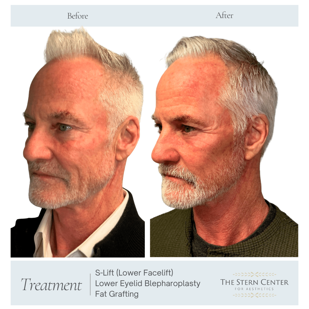 Before and After Image: S-lift + Lower Eyelid Blepharoplasty Fat Grafting - left-front-oblique