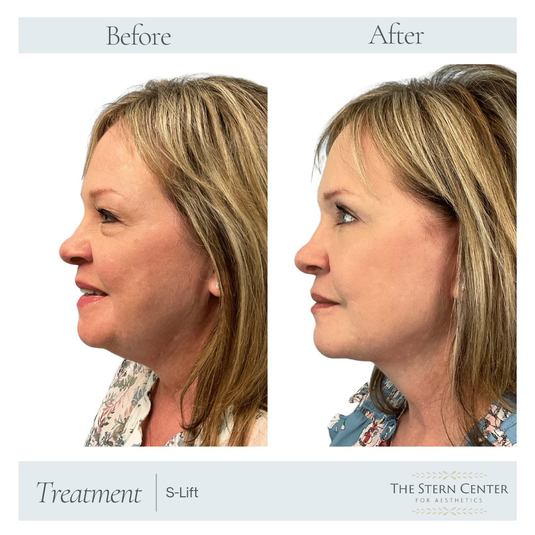 Before and After Image: S-Lift