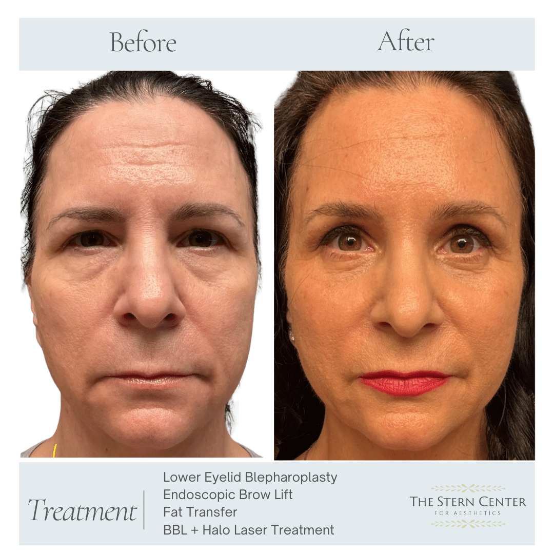 Before and After Image: Eyelid Surgery - front