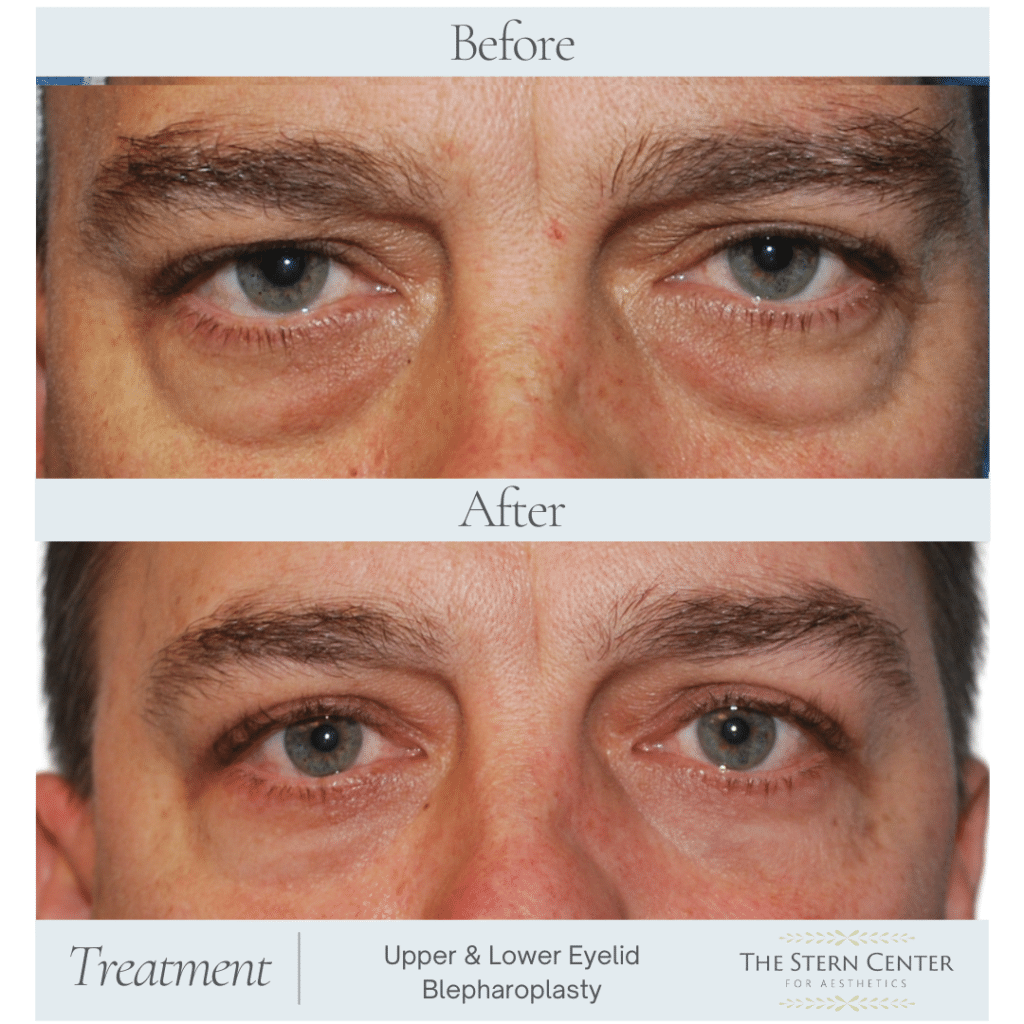 Before and After Image: Upper & Lower Blepharoplasty - front