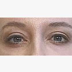 Sutureless Laser Eyelid Surgery