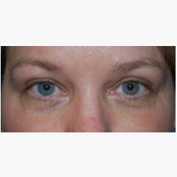 Endoscopic Brow & Forehead Lift with Upper Eyelid Blepharoplasty