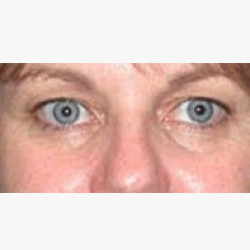 Endoscopic Brow & Forehead Lift with Upper Eyelid Blepharoplasty