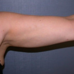 Liposuction Arms