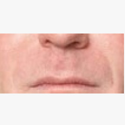 Juvederm® in Nasal Folds