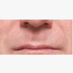Juvederm® in Nasal Folds