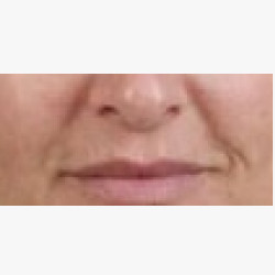 Radiesse® in Cheeks and Nasal Folds