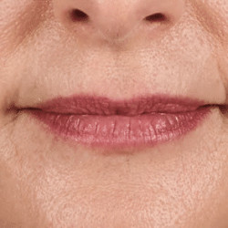 Volbella XC® Lip Augmentation