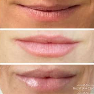 Juvederm Lip Augmentation