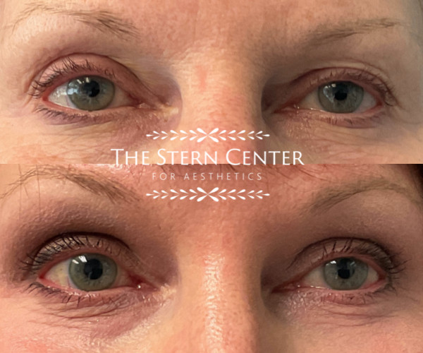 Endoscopic Browlift and Laser of the Upper Eyelids