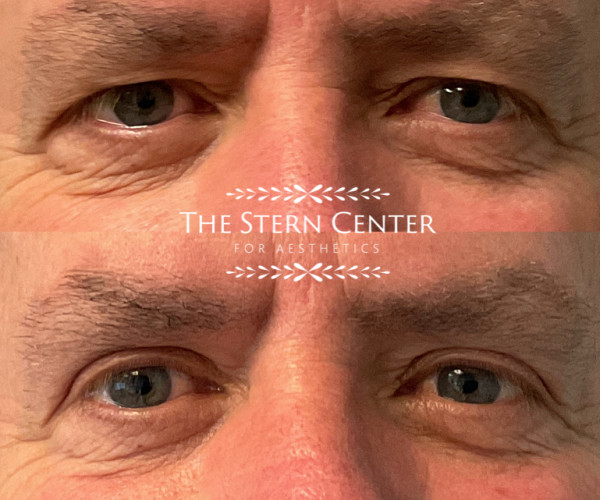 Upper Eyelid Blepharoplasty with Browpexy at The Stern Center in Bellevue WA