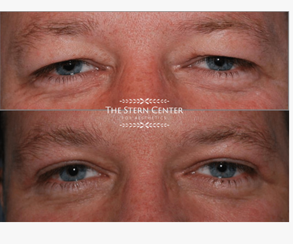 Upper Blepharoplasty with Brow Lift