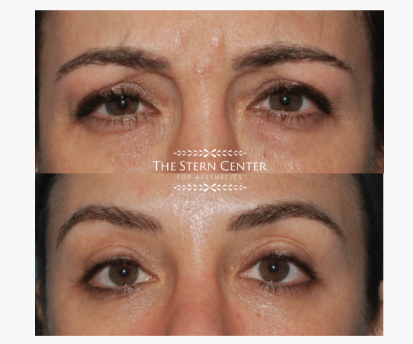 Botox for Brows