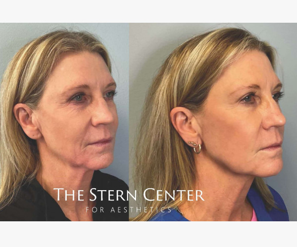 Facial MOXI Laser Treatment & Volux Jawline dermal filler